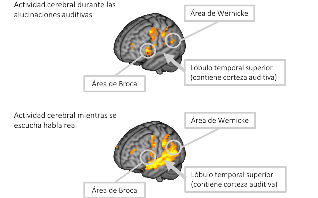 Actividad cerebral durante la esquizofrenia